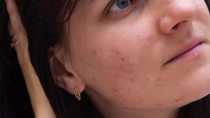 Elimina las manchas en la piel y luce perfecta
