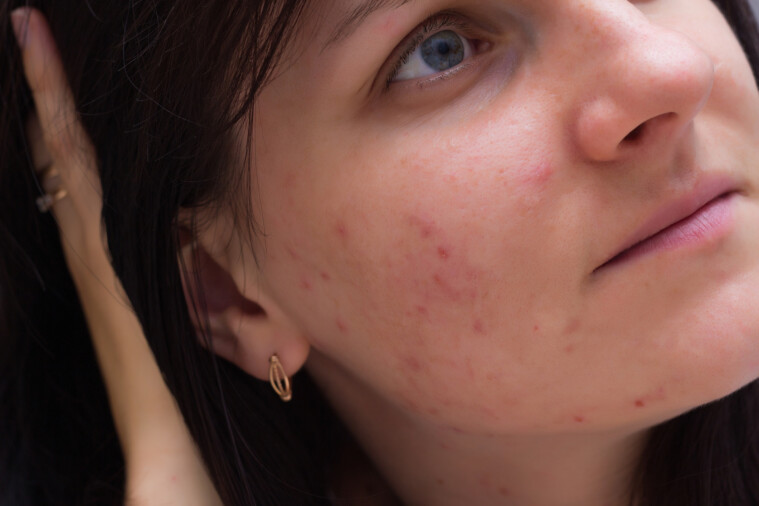 Elimina las manchas en la piel y luce perfecta